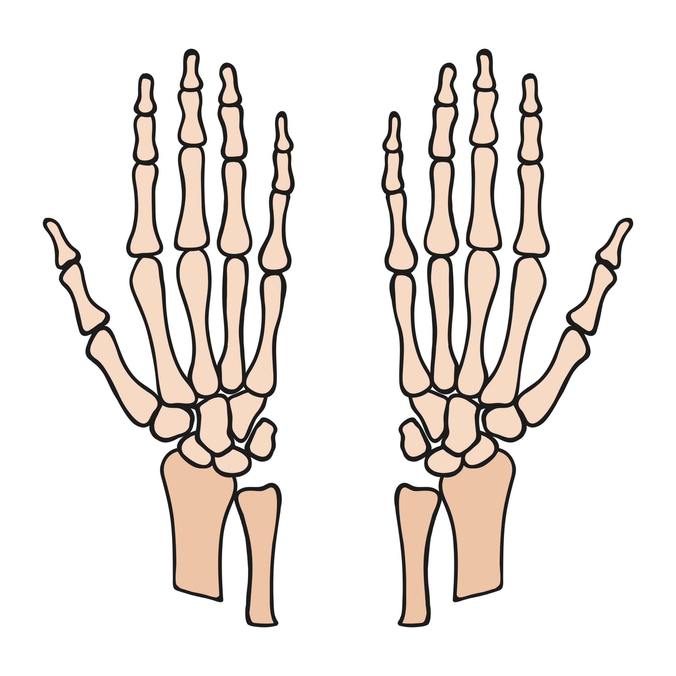 Schemat anatomiczny kości promieniowej, mogący obrazować mechanizm upadku, który stanowi główne złamanie collesa przyczyny.